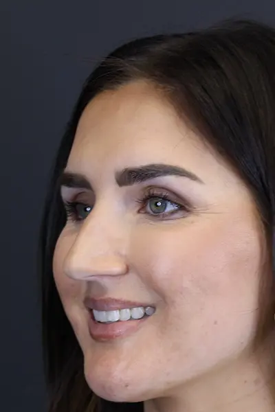 Rhinoplasty case #9707