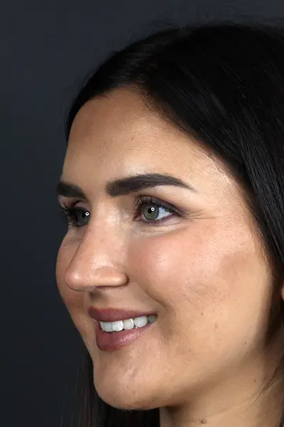 Rhinoplasty case #9707