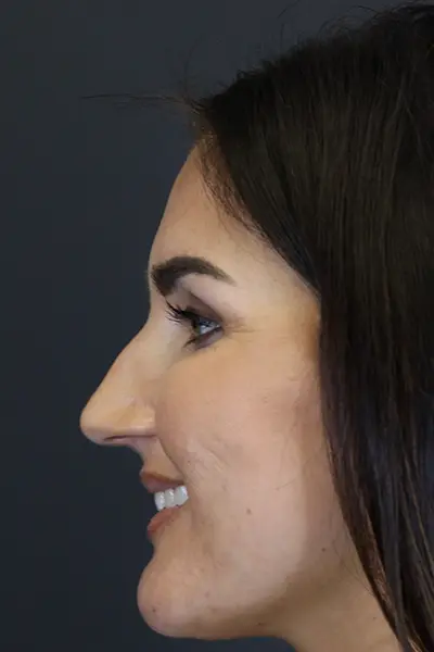 Rhinoplasty case #9707