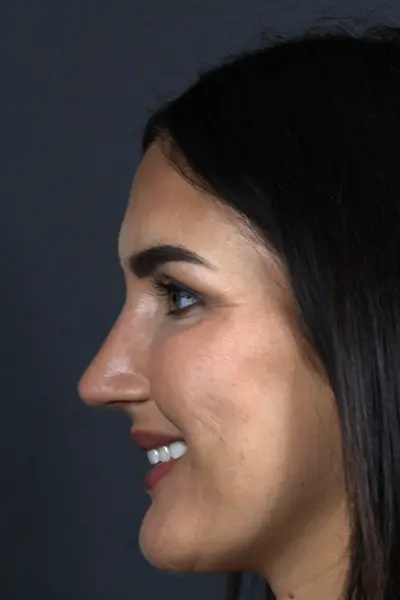 Rhinoplasty case #9707