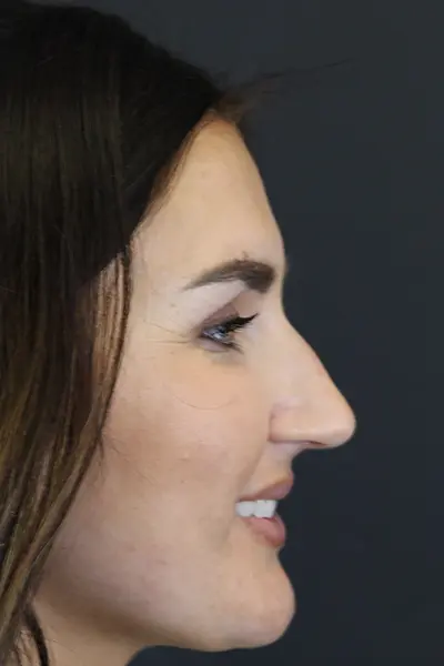 Rhinoplasty case #9707