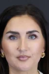 Rhinoplasty case #9707