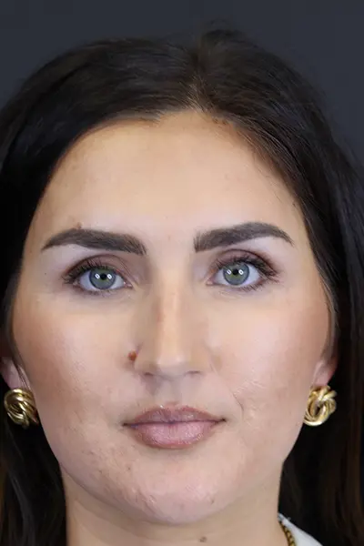 Rhinoplasty case #9707