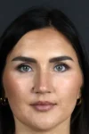 Rhinoplasty case #9707