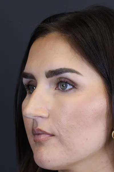 Rhinoplasty case #9707