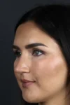 Rhinoplasty case #9707
