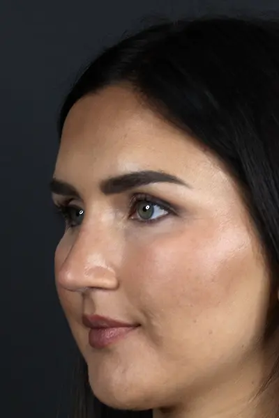 Rhinoplasty case #9707