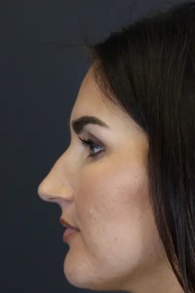 Rhinoplasty case #9707