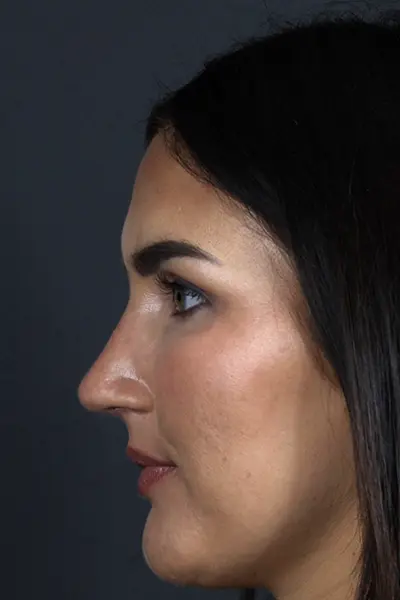 Rhinoplasty case #9707