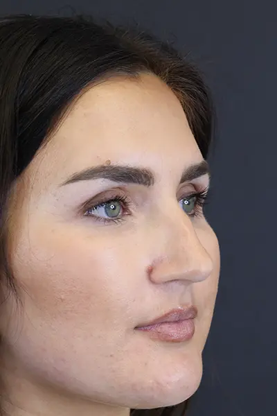 Rhinoplasty case #9707
