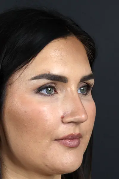 Rhinoplasty case #9707