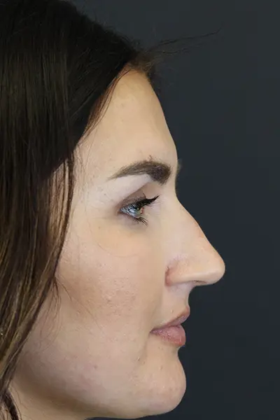 Rhinoplasty case #9707