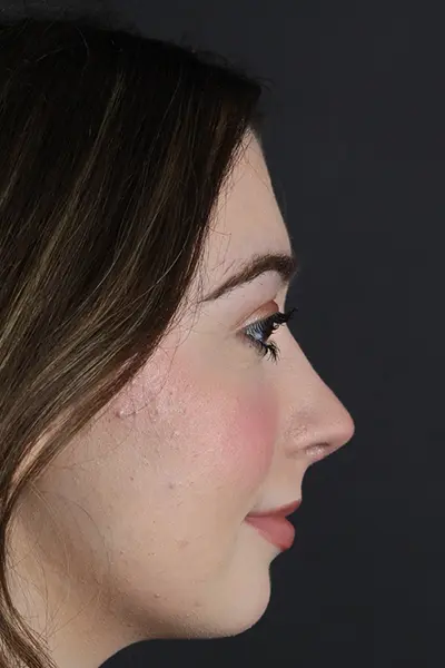 Rhinoplasty case #9650
