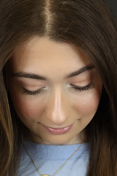 Rhinoplasty case #9650