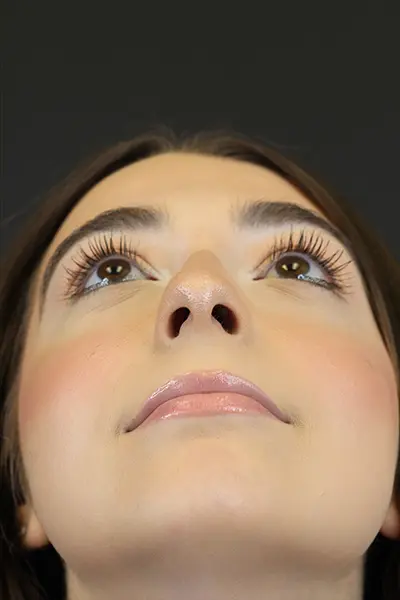 Rhinoplasty case #9650