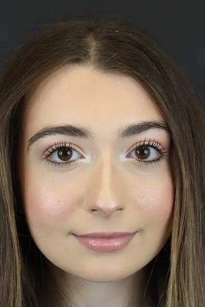 Rhinoplasty case #9650