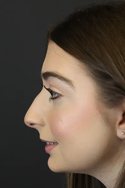 Rhinoplasty case #9650
