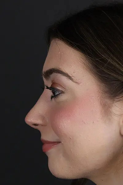 Rhinoplasty case #9650