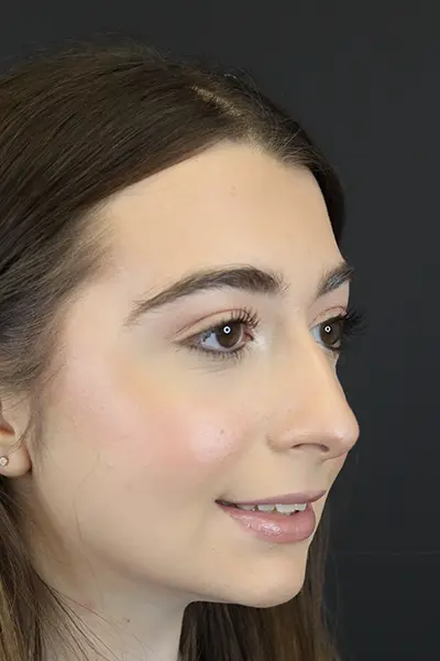 Rhinoplasty case #9650