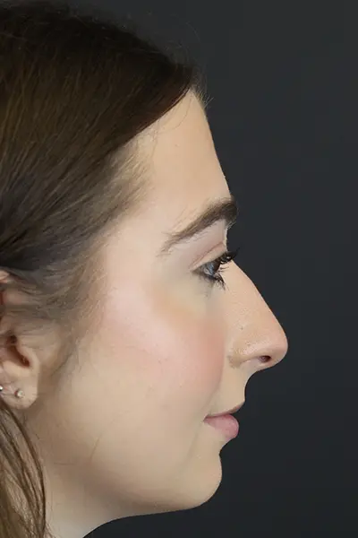 Rhinoplasty case #9650