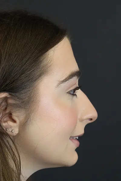 Rhinoplasty case #9650