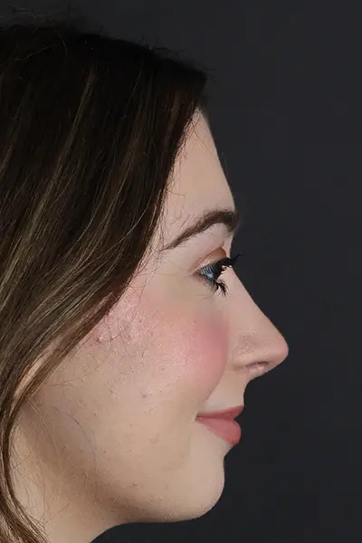 Rhinoplasty case #9650