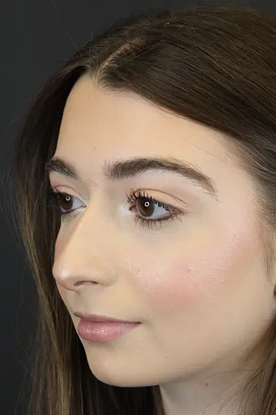 Rhinoplasty case #9650