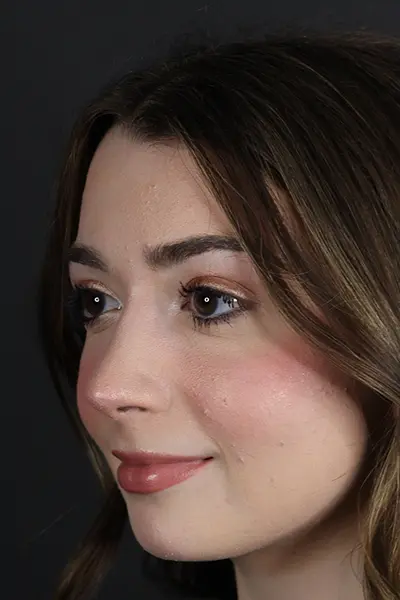 Rhinoplasty case #9650