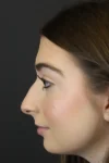 Rhinoplasty case #9650