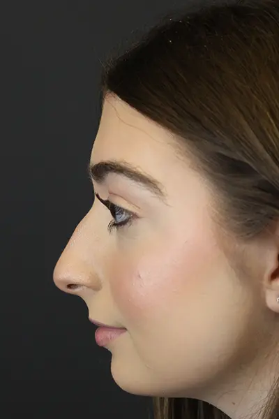 Rhinoplasty case #9650