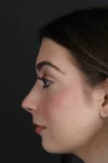 Rhinoplasty case #9650