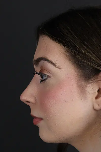 Rhinoplasty case #9650