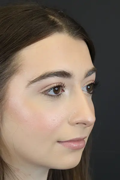 Rhinoplasty case #9650