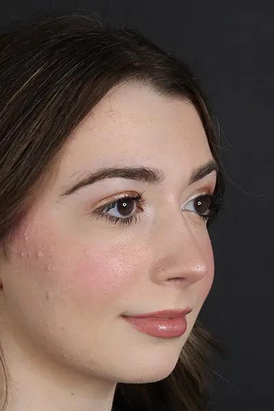 Rhinoplasty case #9650