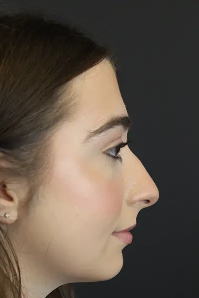 Rhinoplasty case #9650