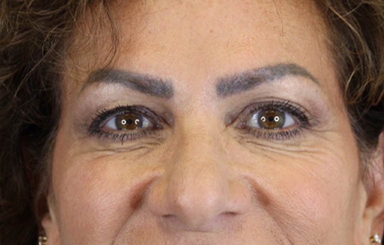 Blepharoplasty case #9929