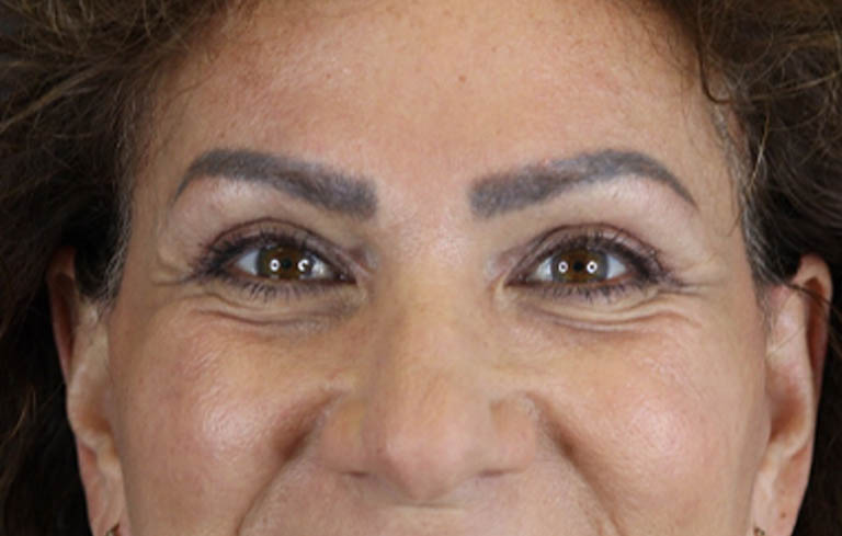 Blepharoplasty case #9929