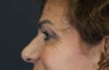 Blepharoplasty case #9929