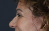 Blepharoplasty case #9929