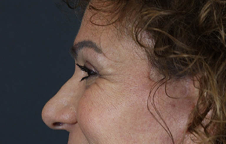 Blepharoplasty case #9929