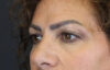 Blepharoplasty case #9929