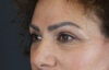 Blepharoplasty case #9929