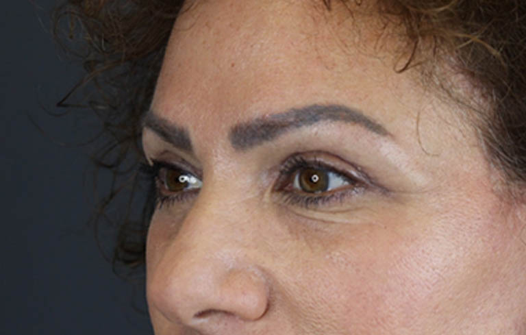 Blepharoplasty case #9929