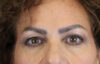 Blepharoplasty case #9929