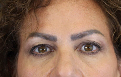 Blepharoplasty case #9929