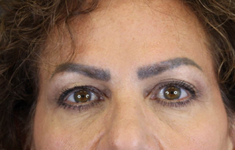 Blepharoplasty case #9929