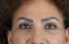 Blepharoplasty case #9929