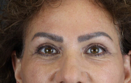 Blepharoplasty case #9929