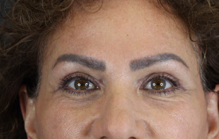 Blepharoplasty case #9929