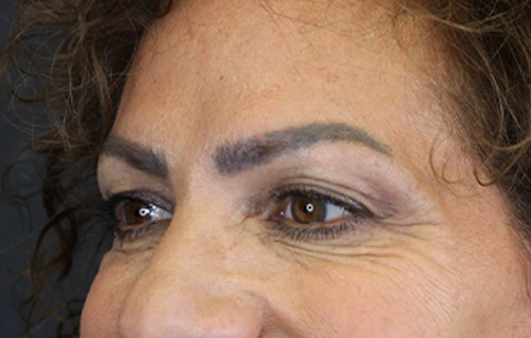Blepharoplasty case #9929